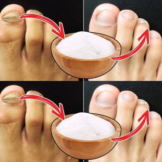 Nail Fungus Removal: 100% Natural Treatment for Toenail Fungus Using Baking Soda