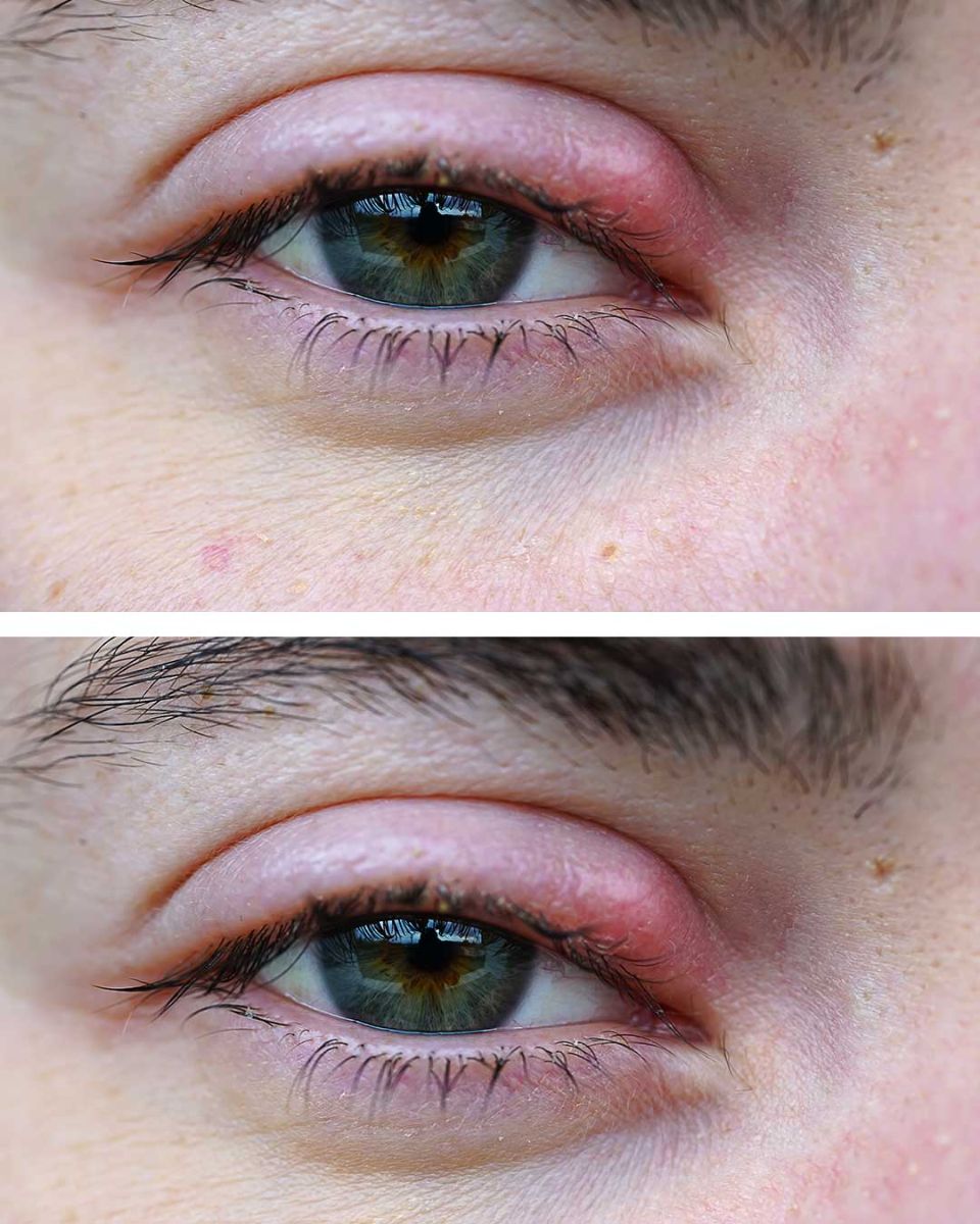 Get rid of a stye in your eye by following these steps