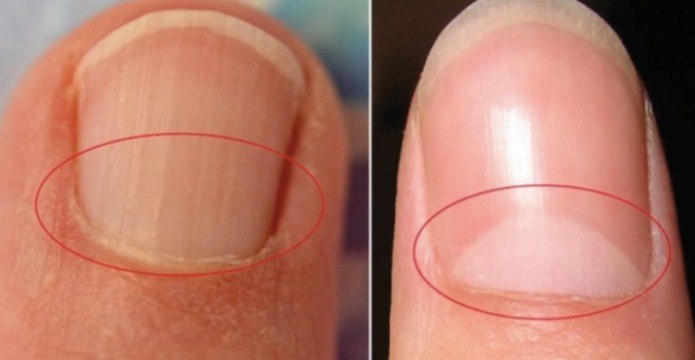 If You Don’t Have A Half Moon Shape On Your Nails, Visit A DOCTOR Immediately