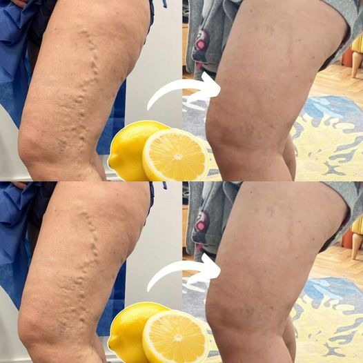 Lemon Treatment for Varicose Veins: Easy and Works Well