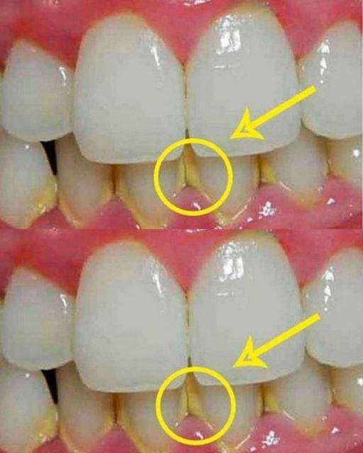 Remove Plaque in 5 Minutes Naturally, Without Going to the Dentist