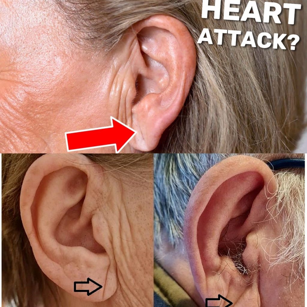 Do You Have This Line on Your Earlobe? You Might Be at Risk