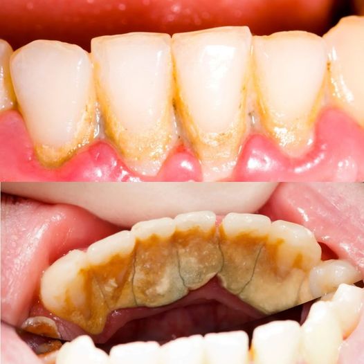 How do you remove strong tartar from teeth?