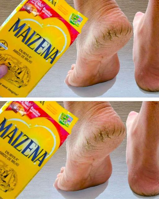 The Best Home Solution To Get Rid Of Cracked Feet Easily