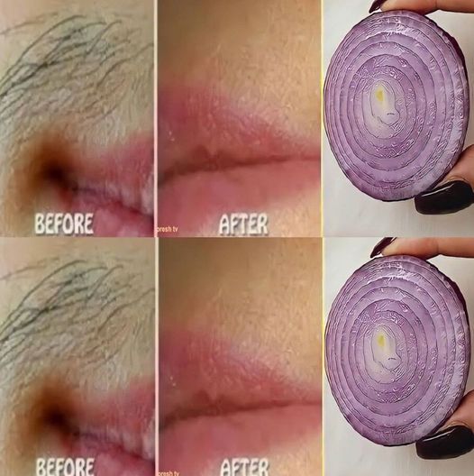 Remove Unwanted Facial Hair Permanently with Onion: A Quick and Natural Remedy