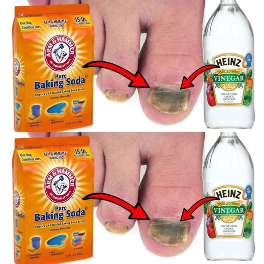 Get rid of toenail fungus naturally with baking soda.