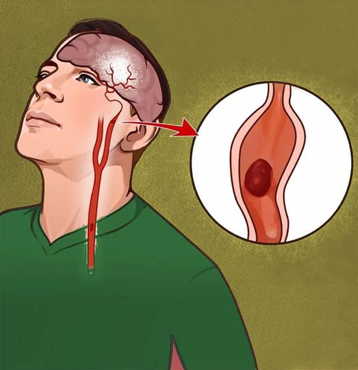 7 warning symptoms of a stroke everyone should know