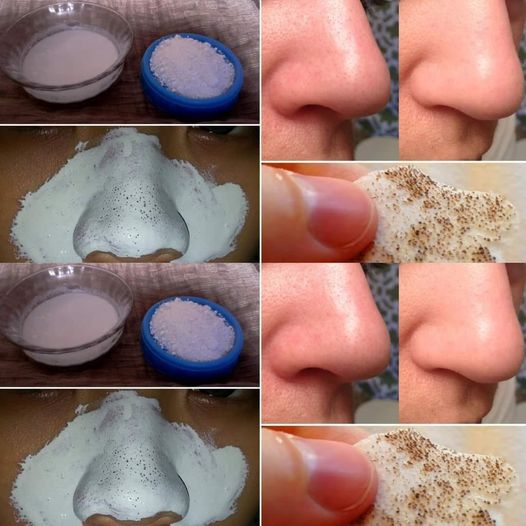 How to Remove Blackheads Naturally