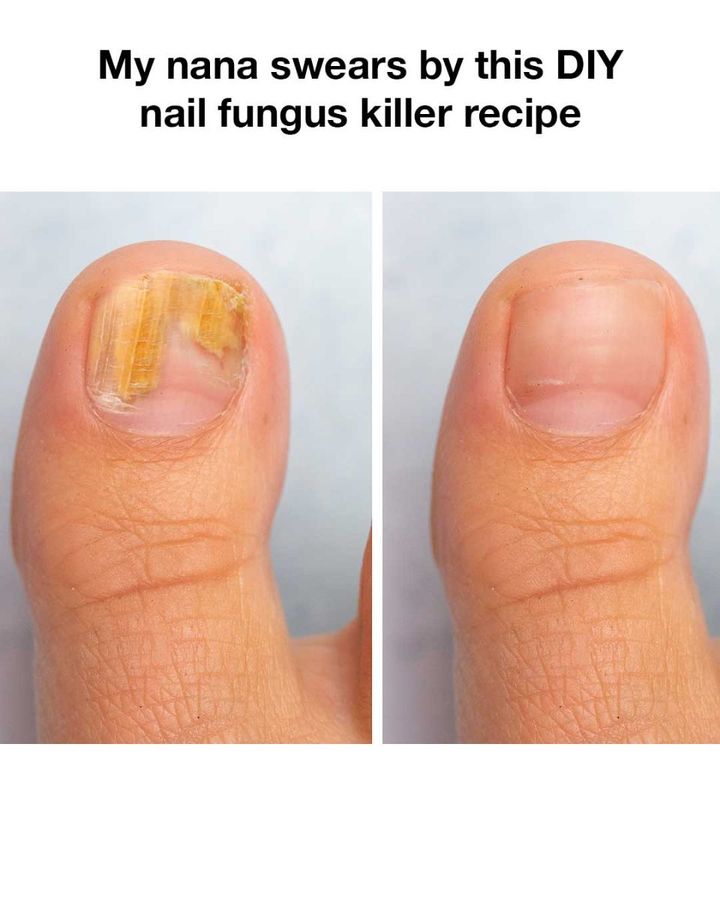 DIY Nail Fungus Killer Recipe: Transform Your Nails Naturally