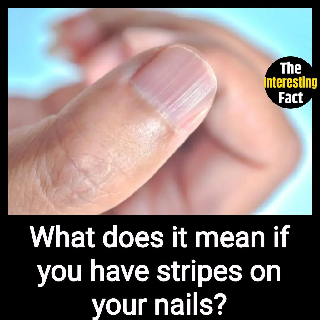 Fingernail Ridges: What Causes Them?