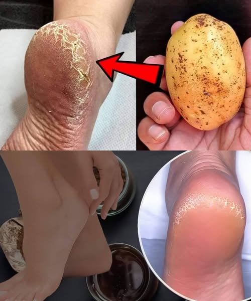 THE EFFECTIVE HOME REMEDY TO PERMANENTLY ELIMINATE FECERATE HEELS