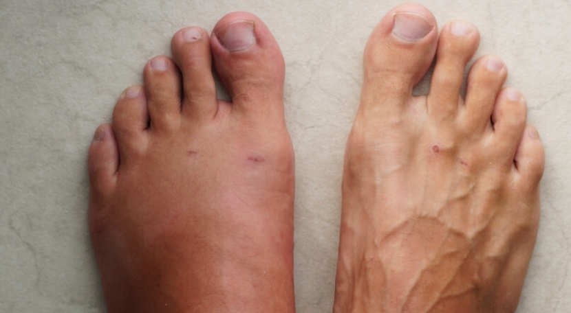 The Power of Vitamin B6: A Natural Solution for Reducing Swelling in Legs and Feet