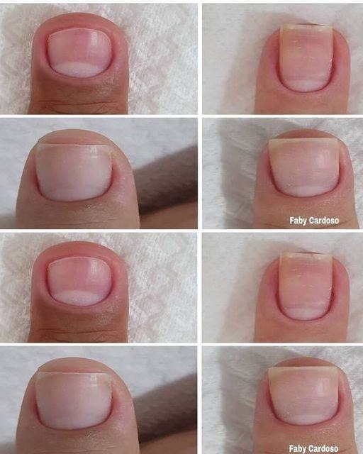 Strengthen Your Nails Naturally with Apple Cider Vinegar