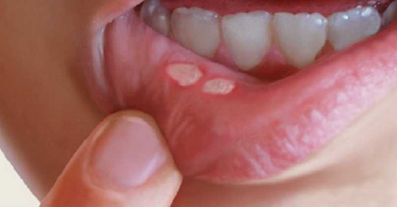 Canker Sores In The Mouth: Here Is How To Naturally Get Rid Of Them In A Matter Of Minutes Without Using Any Medicine