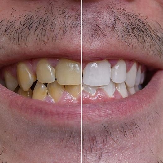 Brighten Your Smile: How to Whiten Yellow Teeth in Just 2 Minutes