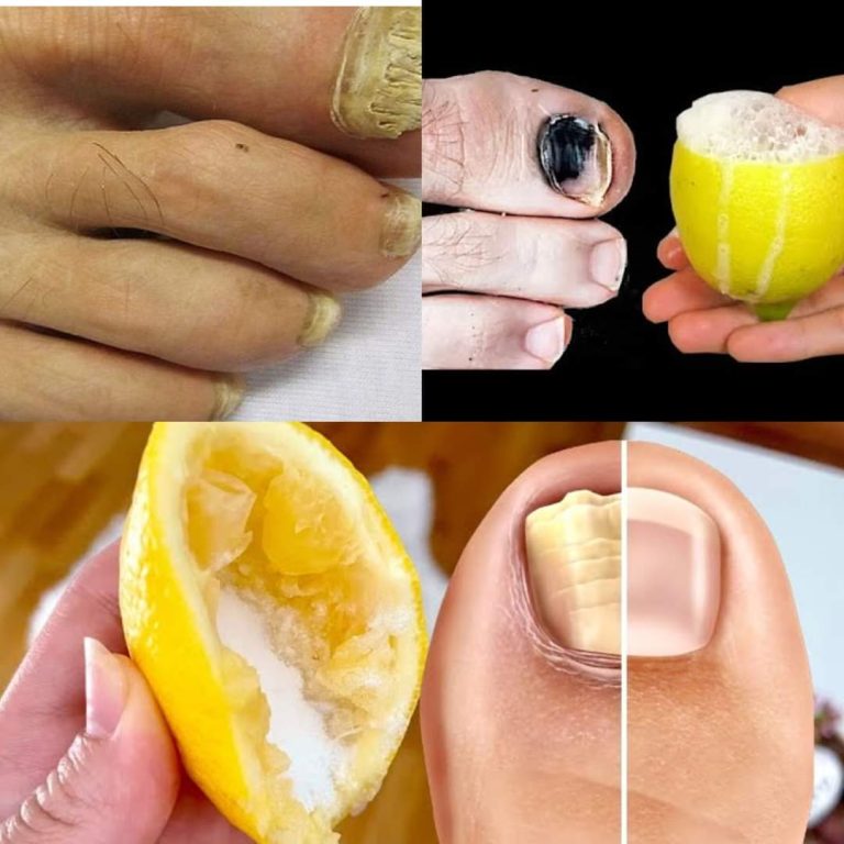 Nail Fungus Removal: 100% Natural Treatment for Toenail Fungus with Lemon and Salt