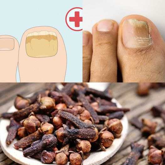 Unlocking the Potential of Cloves: A Comprehensive Strategy for Nail Fungus Relief