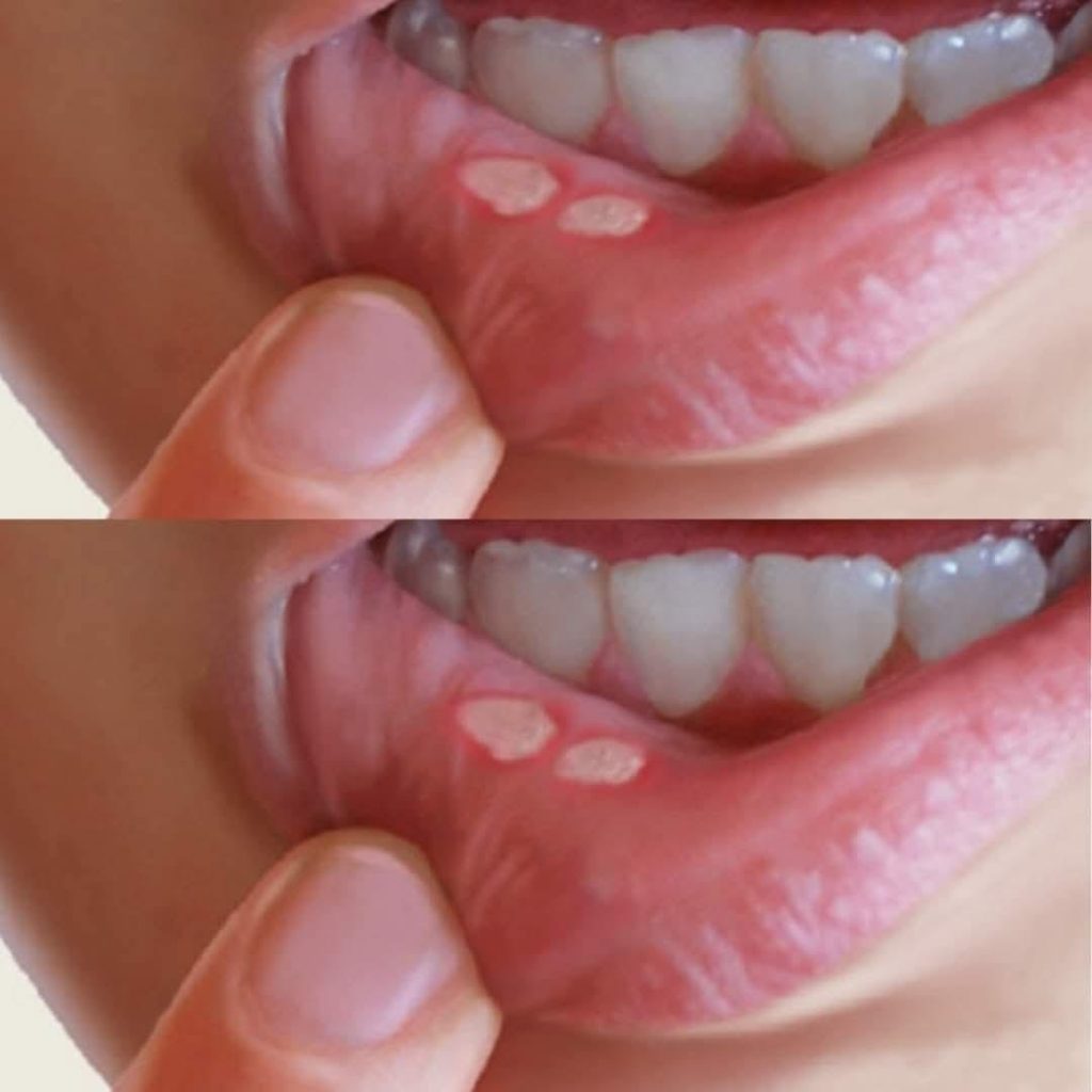 Mouth ulcers: here’s how to get rid of them naturally in minutes without using medication