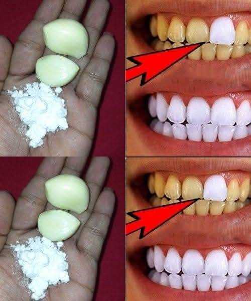 Why Garlic is the Most Important Ingredient for Teeth Whitening