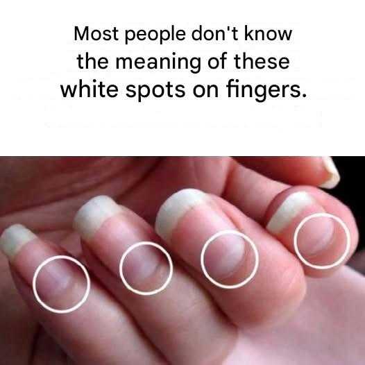 What do white spots on nails mean?