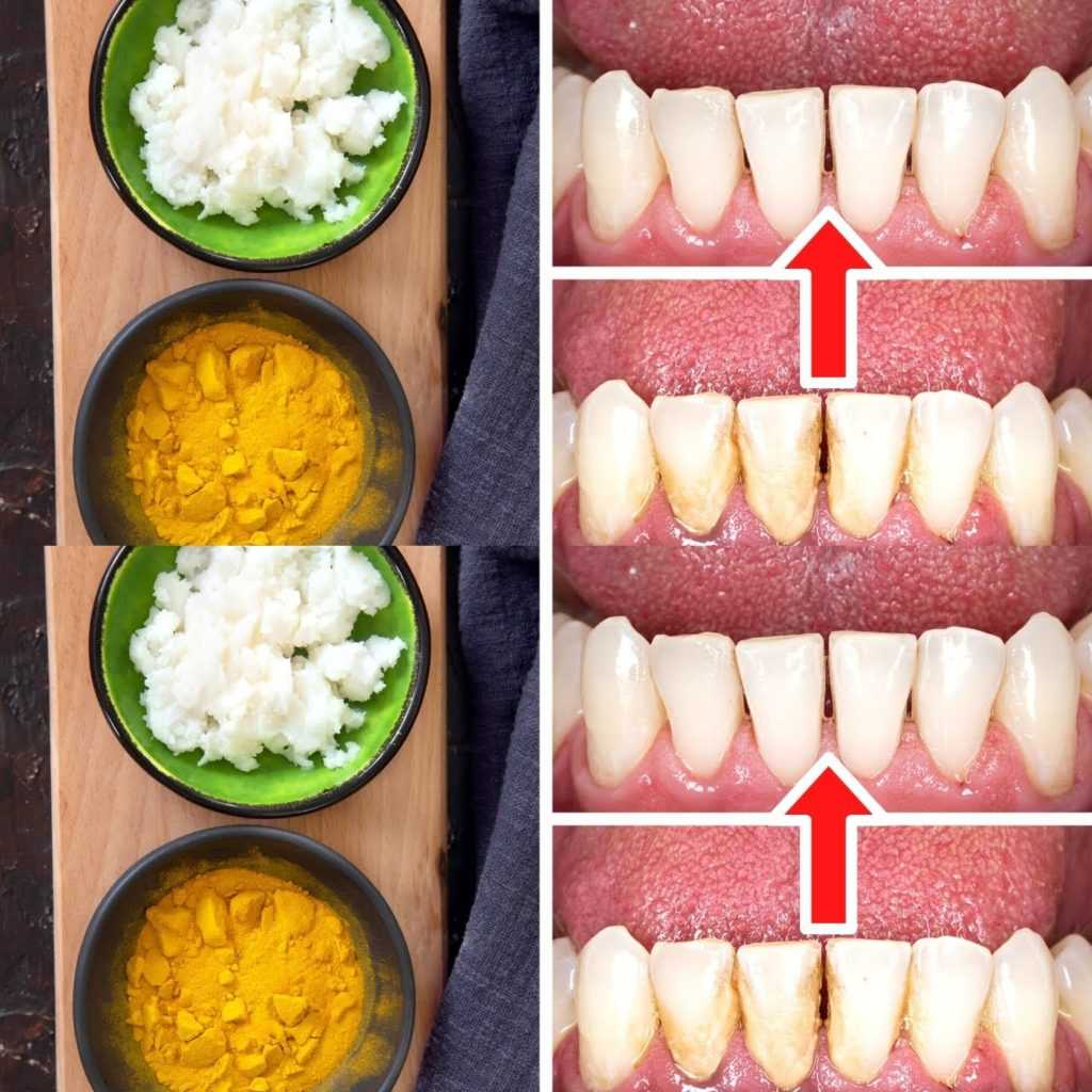 How to Remove Tartar and Plaque from Your Teeth Without a Dentist: Turmeric and Salt