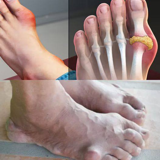 Magnesium: The Key Mineral for Preventing Gout