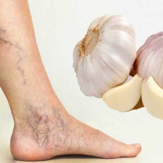 Natural Relief for Varicose Veins: Two Effective Garlic Remedies