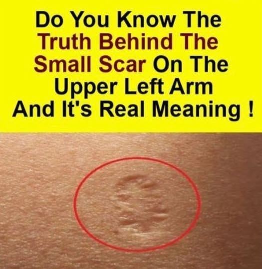 Smallpox vaccine scars: What they look like and why