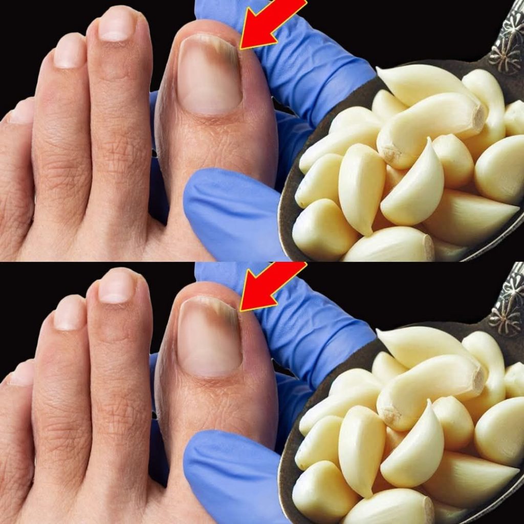 Garlic: A Natural Solution for Nail Fungus