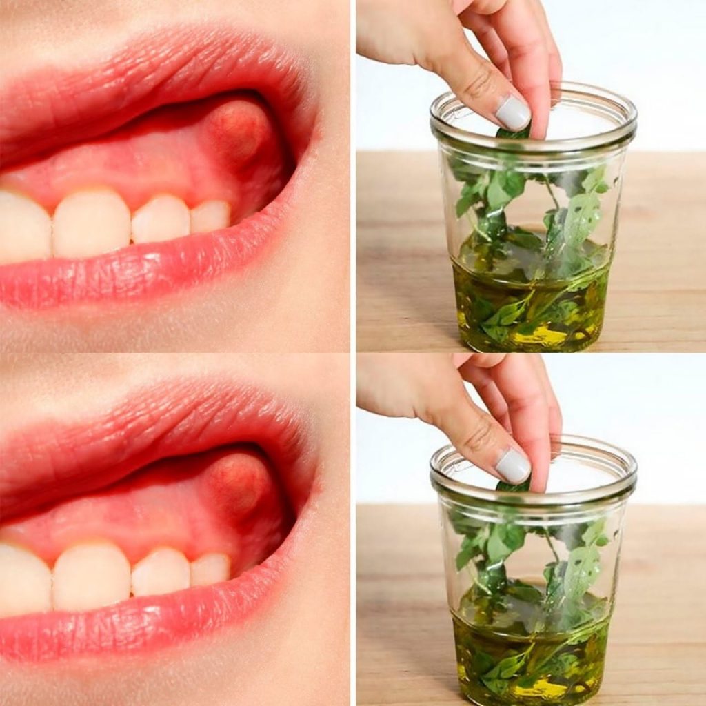 Heal Your Tooth Abscess / Dental Infection Naturally with Oregano Oil