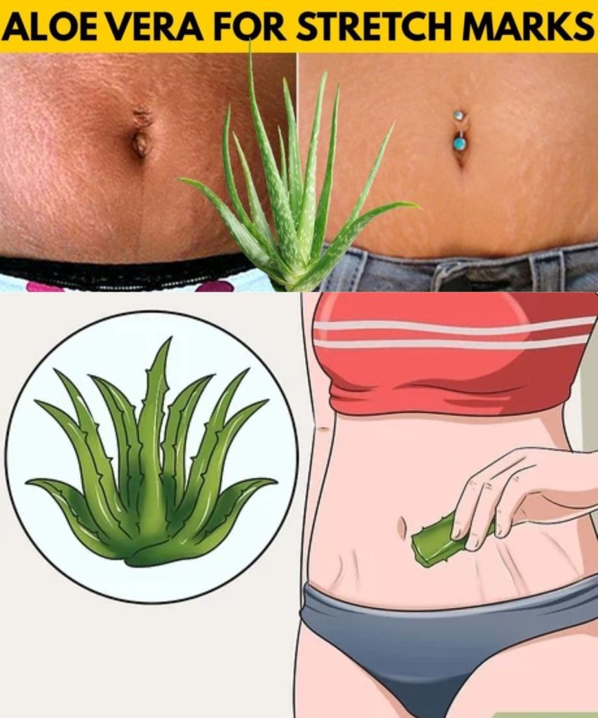 Did You Know Aloe Vera Can Erase Stubborn Stretch Marks?