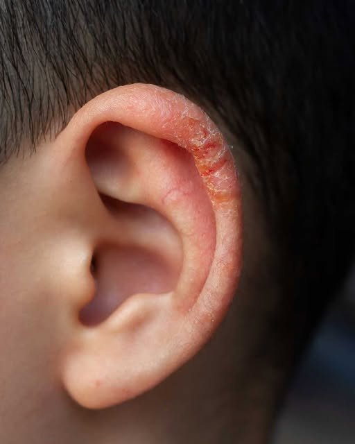 Found this weird skin on my son’s ear this morning. Doc appt is a week away. What can I do?