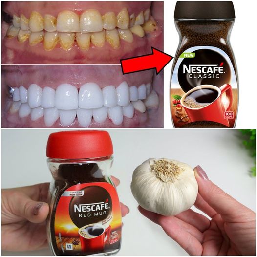 Natural Teeth Whitening at Home: A Surprising Solution with Garlic and Coffee