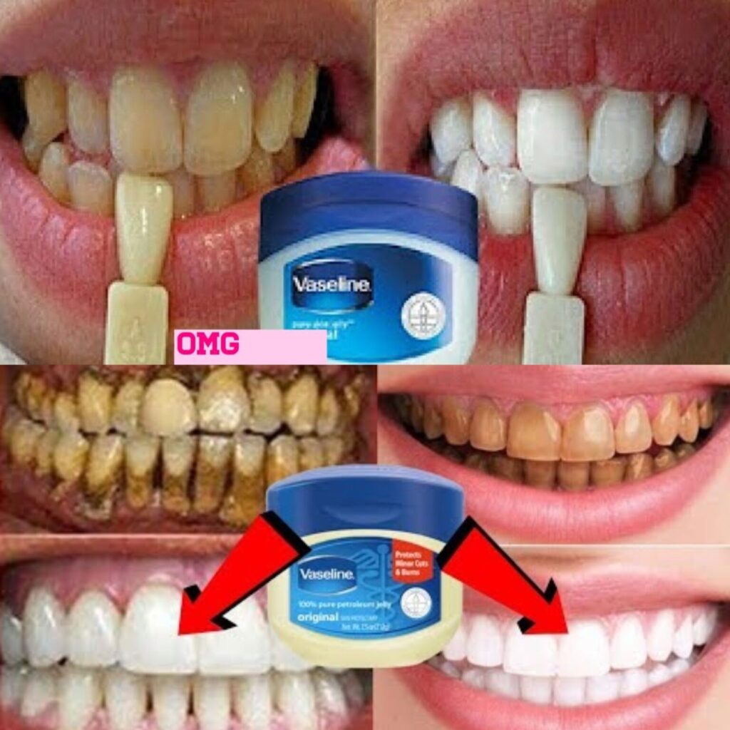 Make Your Smile Brighter the Natural Way: Using Vaseline to Whiten Your Teeth