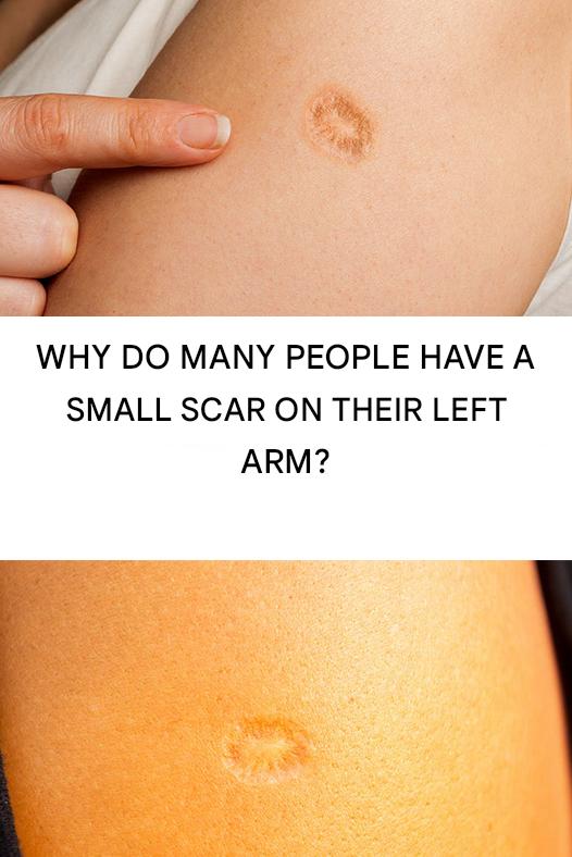 Why do many people have a small scar on their left arm?