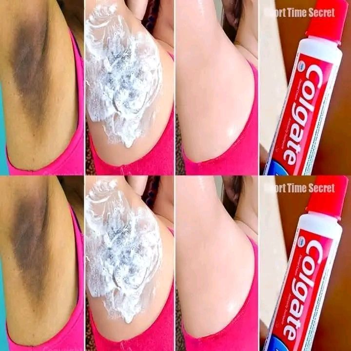 Apply Toothpaste on Your Dark Underarms and See the Magic: A Simple Whitening Remedy