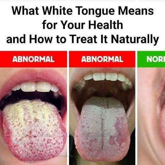 What White Tongue Means for Your Health and How to Treat It Naturally