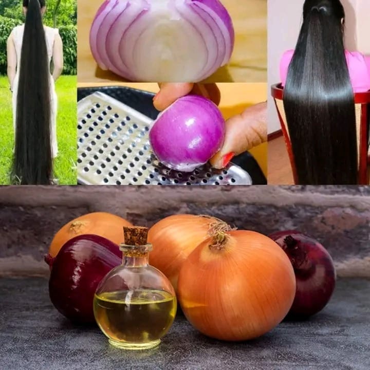 How to Use Onion Juice for Extreme Hair Fall, Hair Loss & Dandruff