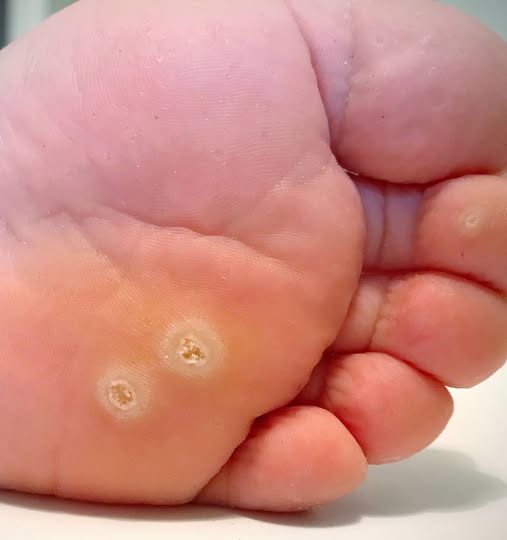 Got rough, thickened skin on my feet. No podiatrist availability soon. Any ways to reduce discomfort?