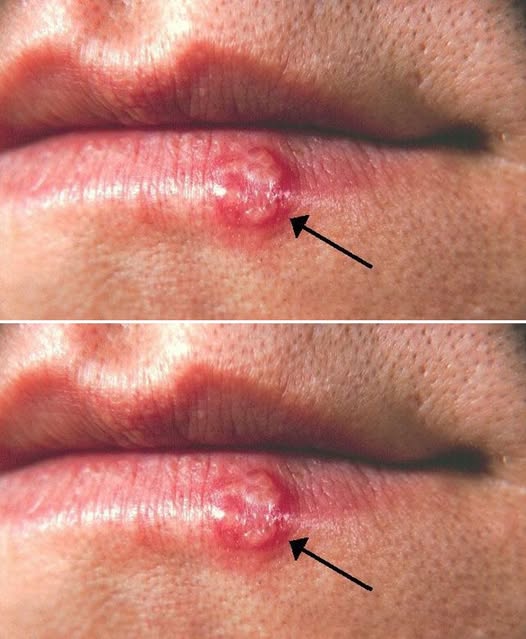 Most people have had or have this cold sore virus, but very few know how to cure it. What you should do is.