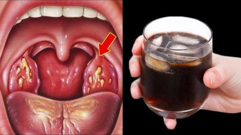 Natural Antibiotics for Sore Throat – Effective Recipes That Work Overnight!