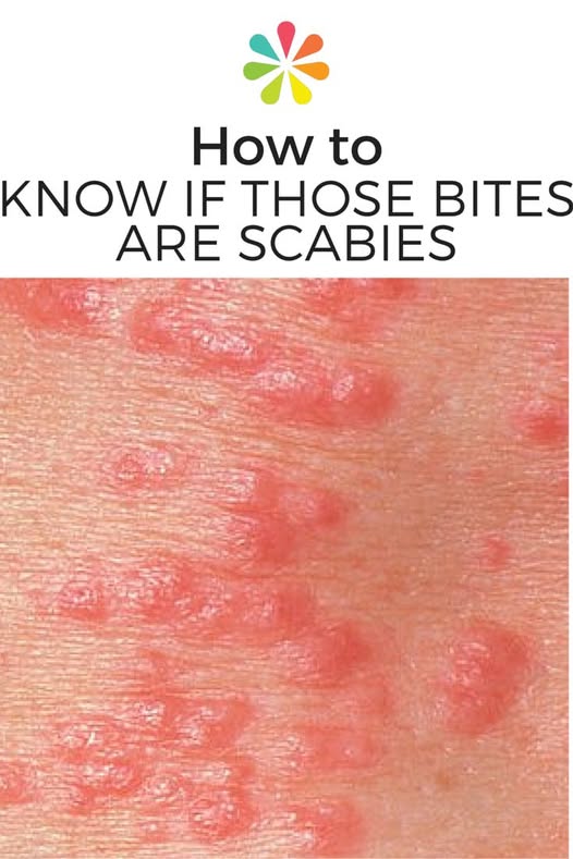 How to Know if That Rash Is Scabies