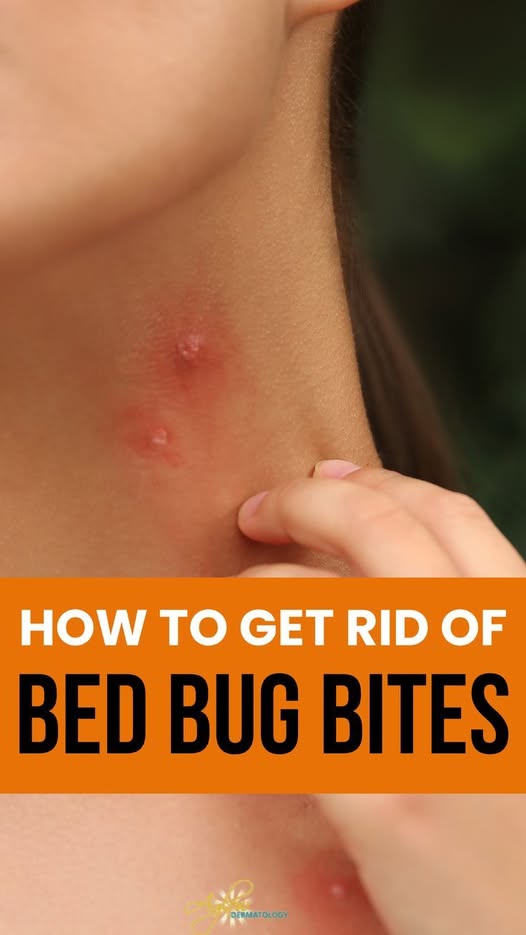 How Do I Get Rid of Bed Bug Bites