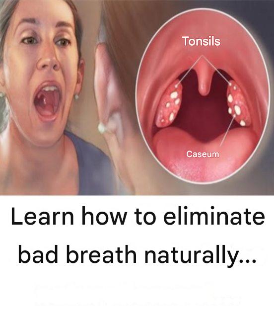 10 Tips to Get Rid of Tonsil Stones for Good