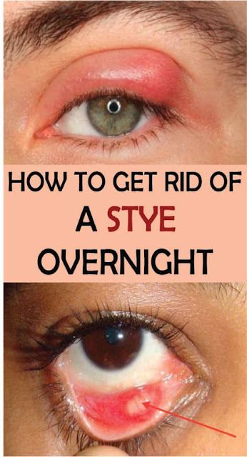 How To Get Rid Of A Stye Overnight