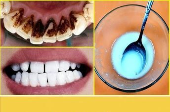 No Need To Go To The Dentist: Remove Plaque And Tartar With Just This Mixture