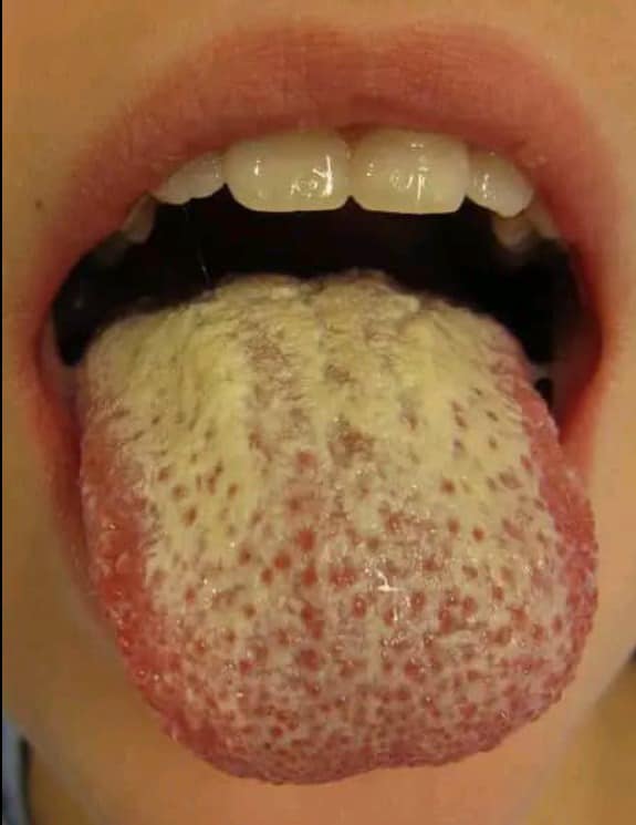 If you have a white tongue this means