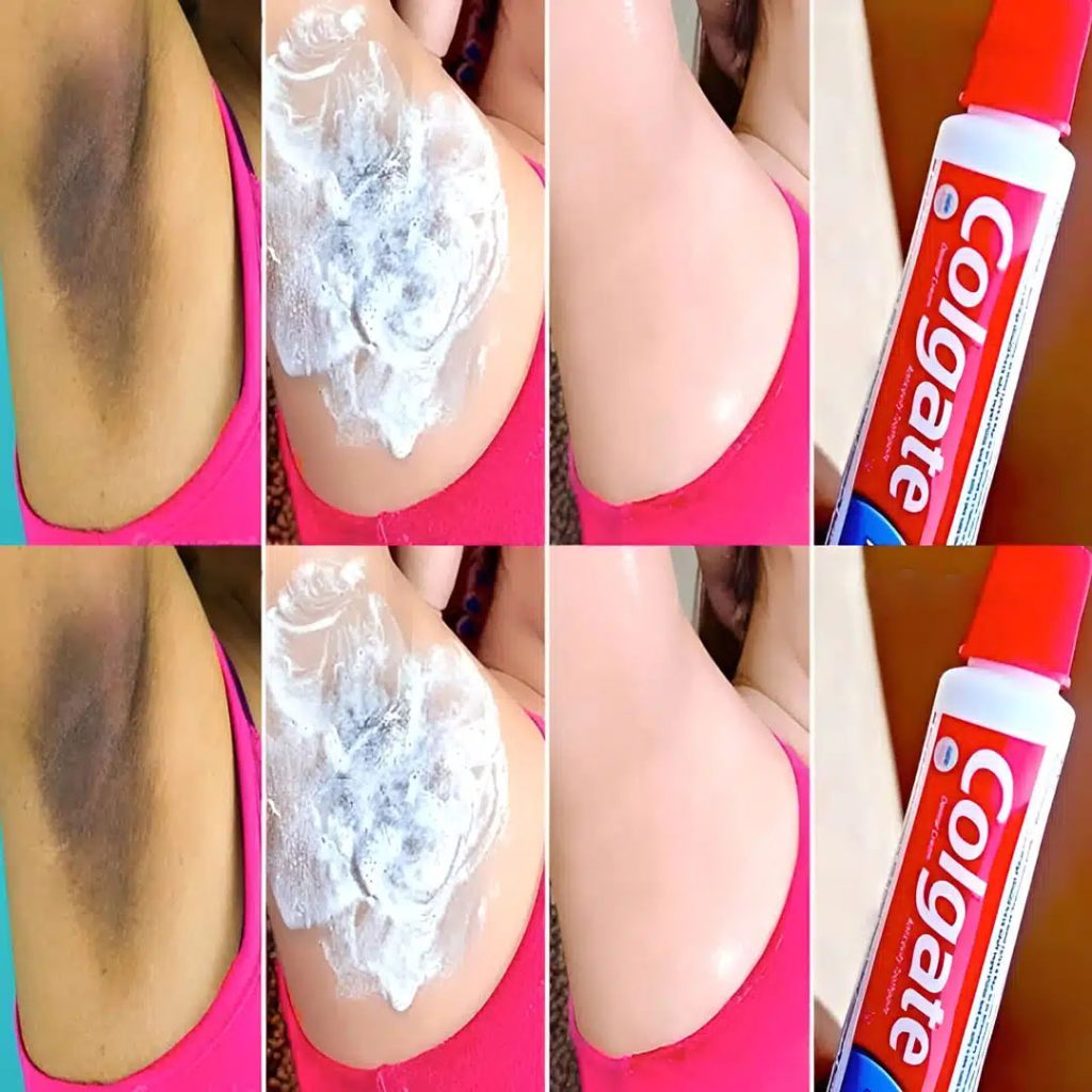 How to whiten armpits with toothpaste?