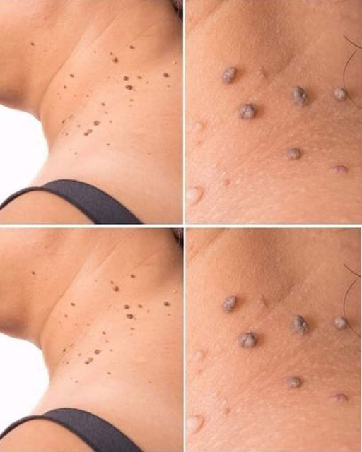 5 Tips to Help You Get Rid of Skin Tags