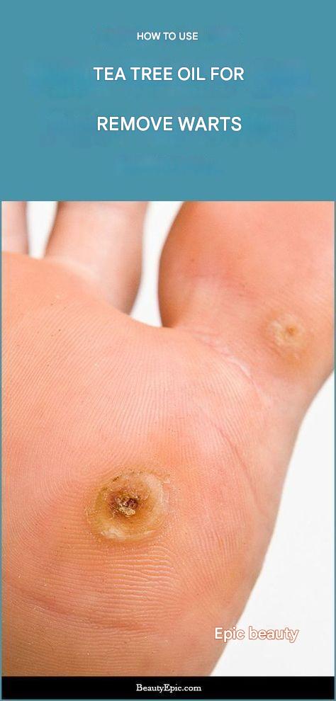 How to remove warts with tea tree oil? … See more